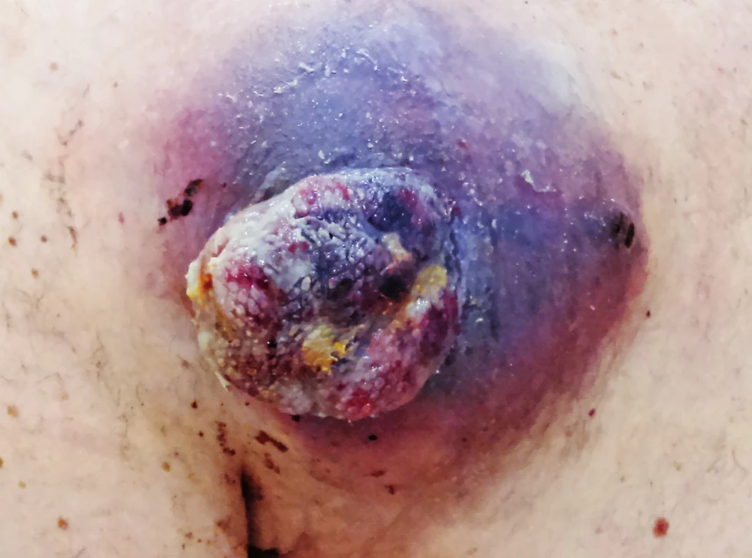 Patient with a recurrence of melanoma in a scar above scapula on the left after sufficient wide excision