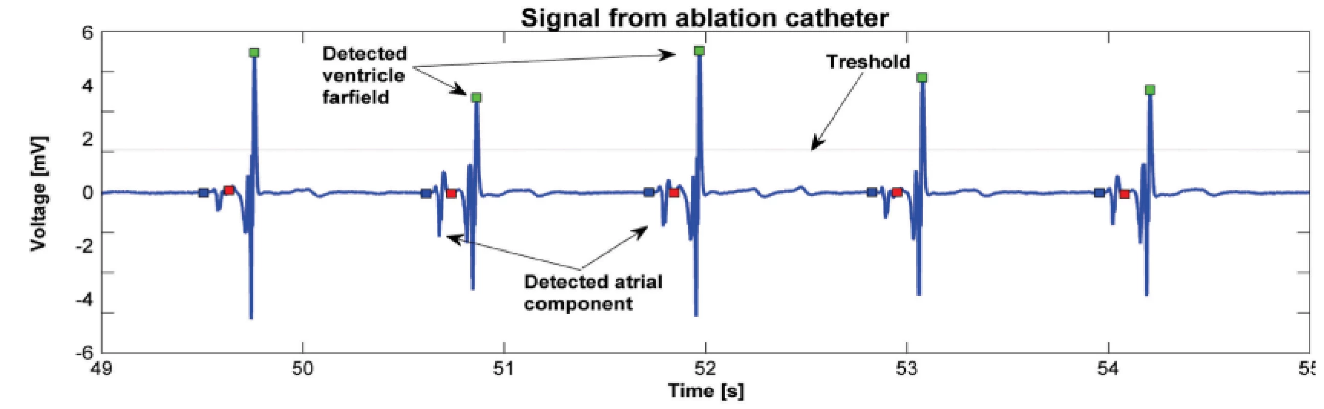Activation wave detection using thresholding. Atrial component of the signal in front of the ventricle far-field is selected for further analysis.