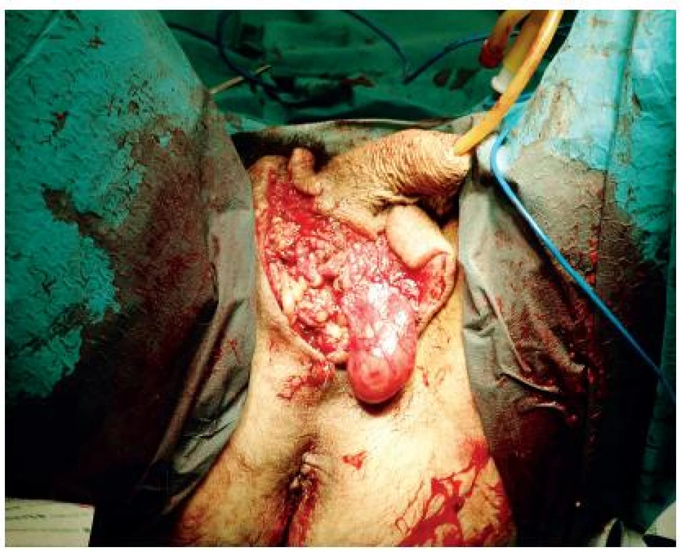 Peroperační snímek, excise primárního tumoru
Fig. 2. Peroperative foto, excison of the tumor