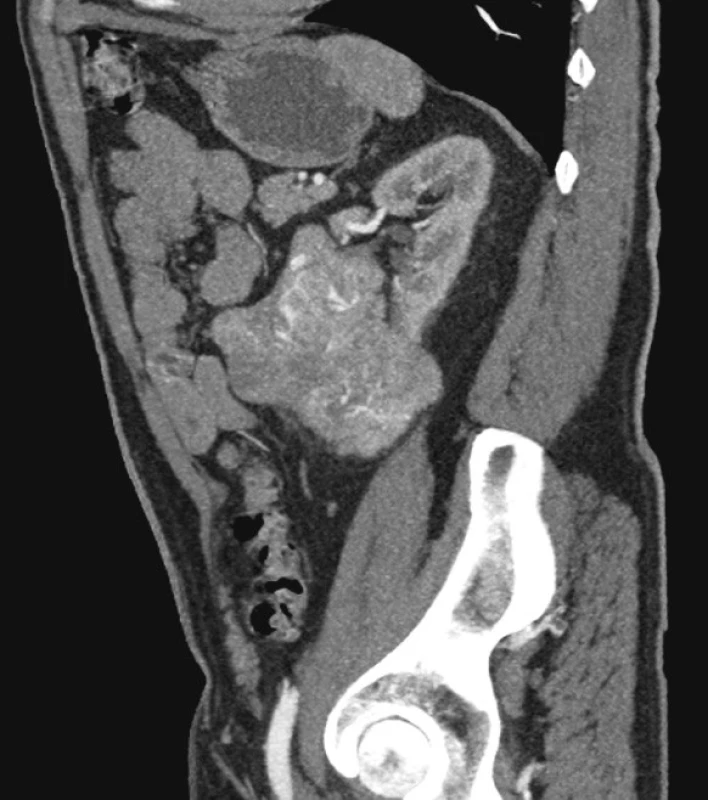 CTA obraz tumoru levé ledviny
Fig. 1. CTA view of the left kidney tumor