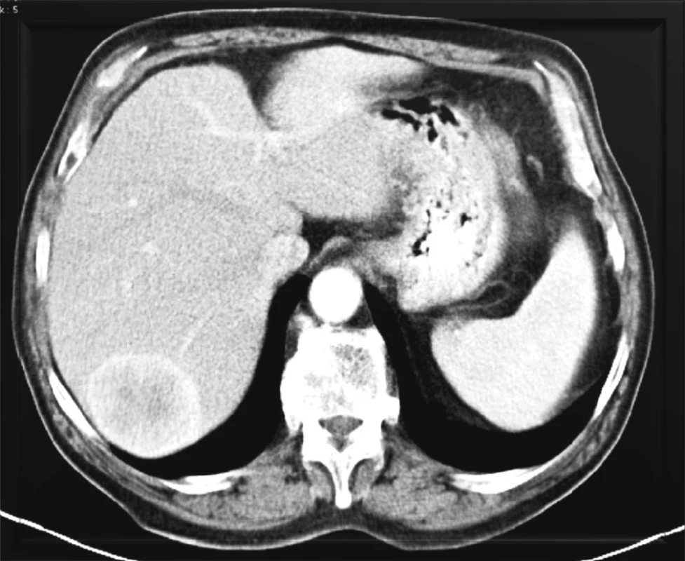 Hypervaskularizovaná metastáza karcinoidu v pravém laloku jater
Fig. 1. Hypervascularized carcinoid metastasis in the right liver lobe