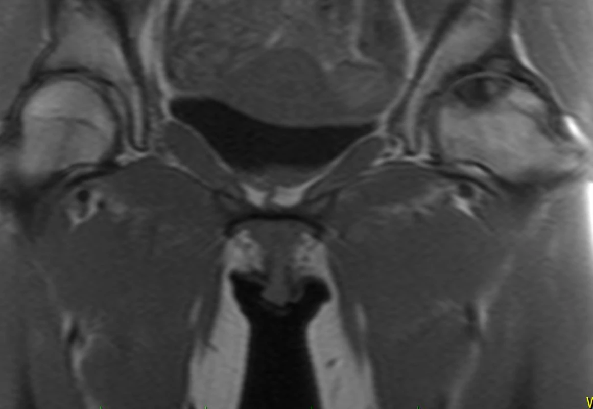 MRI nekrózy hlavice femuru