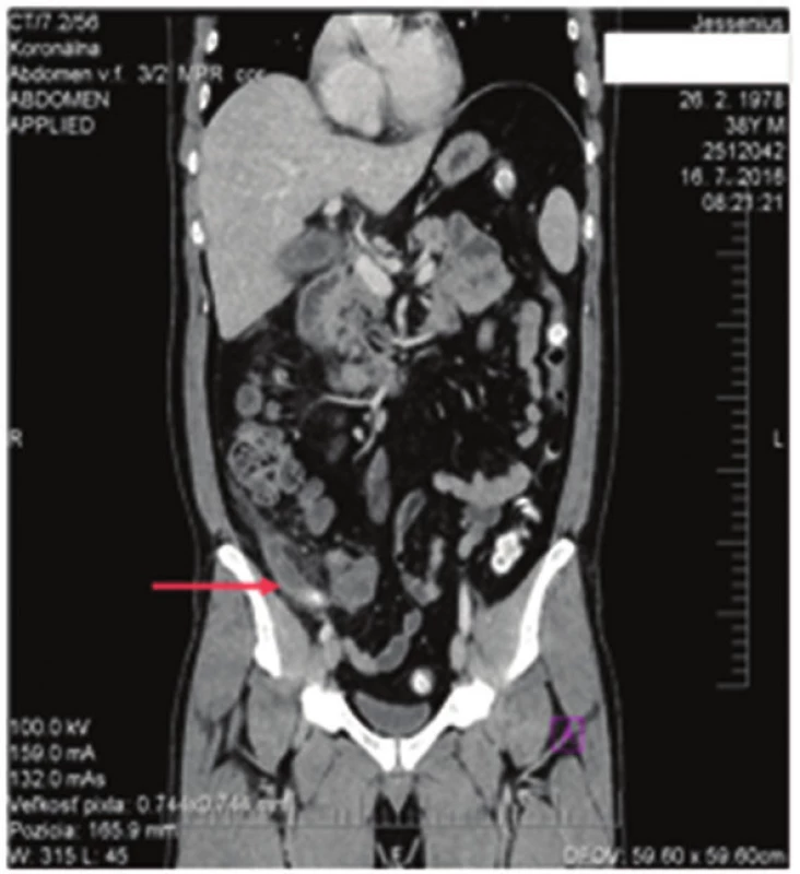 Akútna apendicitída
Fig. 1: Acute appendicitis