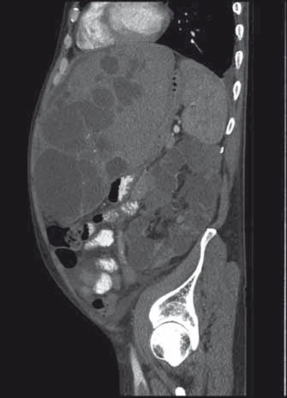 Expanze jater a ledvin při polycystóze.
Fig. 3. Polycystic liver and kidney expansion.