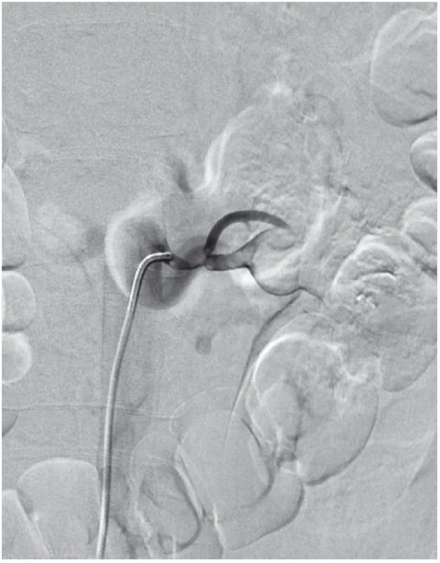 Angiografie levé renální tepny před revaskularizací – defekt v náplni kmene renální arterie 
Fig. 2. Left renal artery angiography before intervention – filling defect in the renal artery trunk