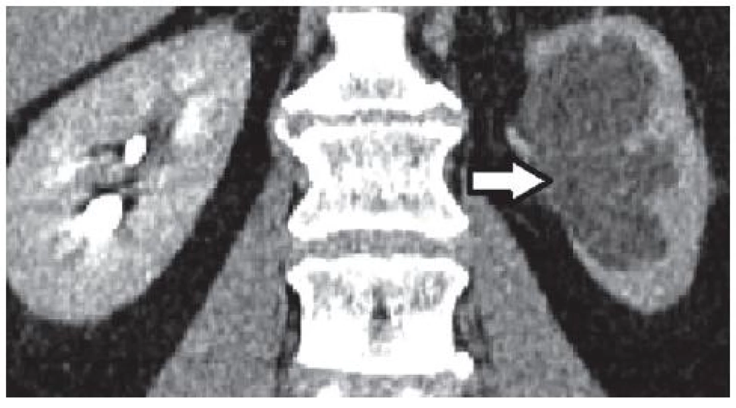 CT po podání intravenózní kontrastní látky – šipka ukazuje na afunkční ledvinu vlevo s hydronefrózou
Fig. 4. CT after administration of intravenous contrast material – the arrow points to the left non-functioning kidney with hydronephrosis