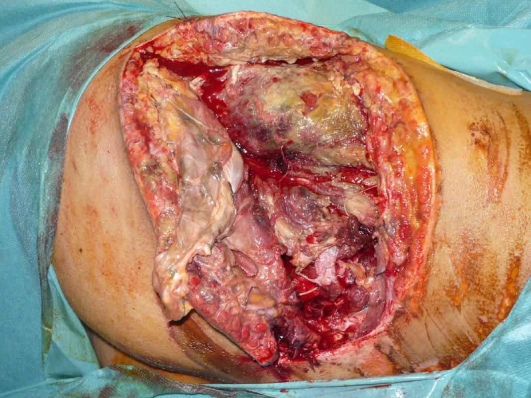 Stav měkkých tkání před debridementem na operačním sále, následovala léčba v hyperbarické komoře