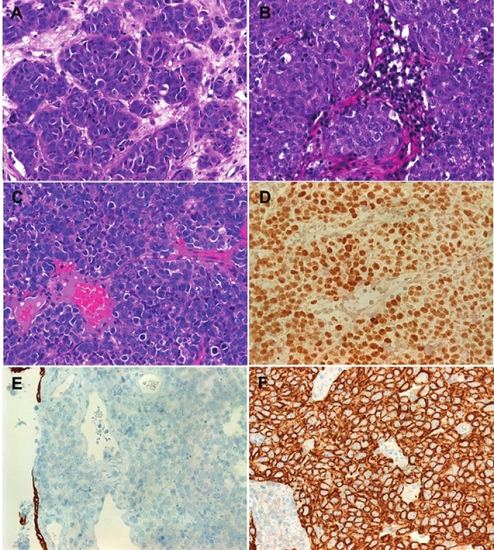 SNUC cases display nested (A) or diffuse (C) growth of large anaplastic cells with prominent nucleoli and absent expression of CK5/6 (E). Similar pattern as SNUC seen in a case of lymphoepithelial carcinoma with subtle inflammatory reaction (B), but strong positivity for EBER1/2 (EBV) by in situ hybridization (D). In contrast to typical SNUC, lymphoepithelial carcinoma shows strong expression of CK5/6 (F).