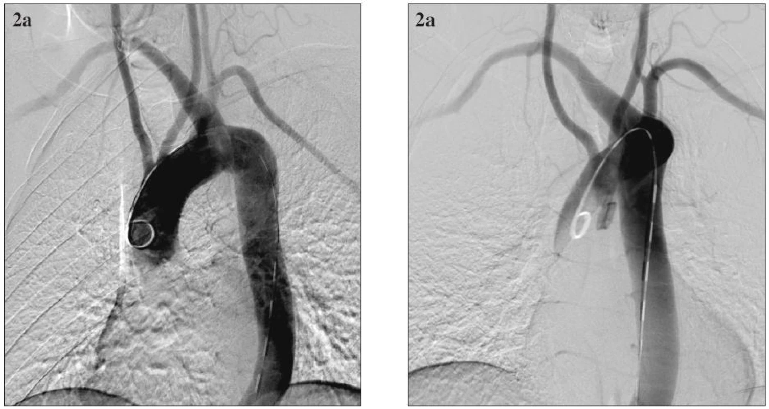 54-ročný muž s aneuryzmatickou dilatáciou anomálne odstupujúcej arteria subclavia dextra (arteria lusoria) a aneuryzmou Kommerellovho divertikla. Digitálna subtrakčná angiografia aortálneho oblúka a supraaortových vetiev. Obr. 2a. predozadná projekcia; Obr. 2b. šikmá projekcia.
Fig. 2. A 54- year old male with aneurysmal dilatation of an abnormal arteria subclavia dextra (arteria lusoria) and with the Kommerell diverticle aneurysm. Digital subtraction angiography of the aortic arch and supraaortic branches. Fig. 2a. A-P view; Fig. 2b. oblique view. 