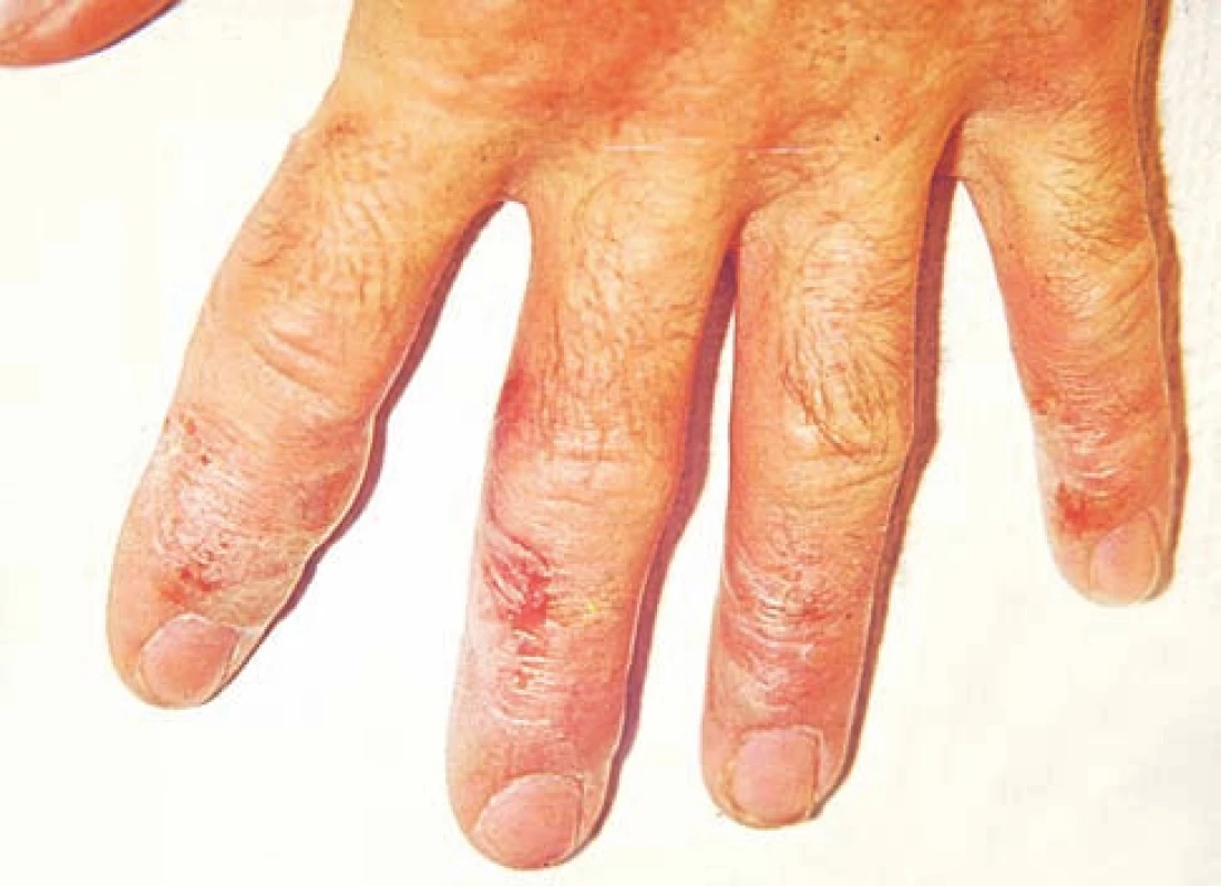 Eczema contactum prof. – epoxidy (lepidlo)