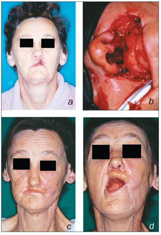 A 62 year-old lady presented with a T2N1M0 squamous cell carcinoma of the upper lip (a); the defect after tumour resection (b); functional result after upper lip reconstruction using folded radial forearm free flap (c, d)