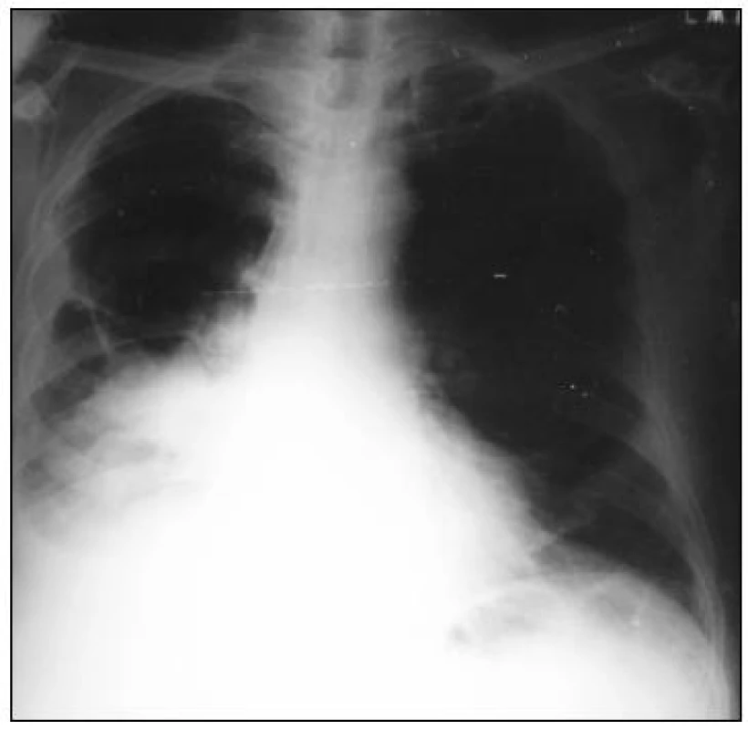 RTG pľúc v PA projekcii – diagnóza adenokarcinom pľúc vpravo, z azbestu