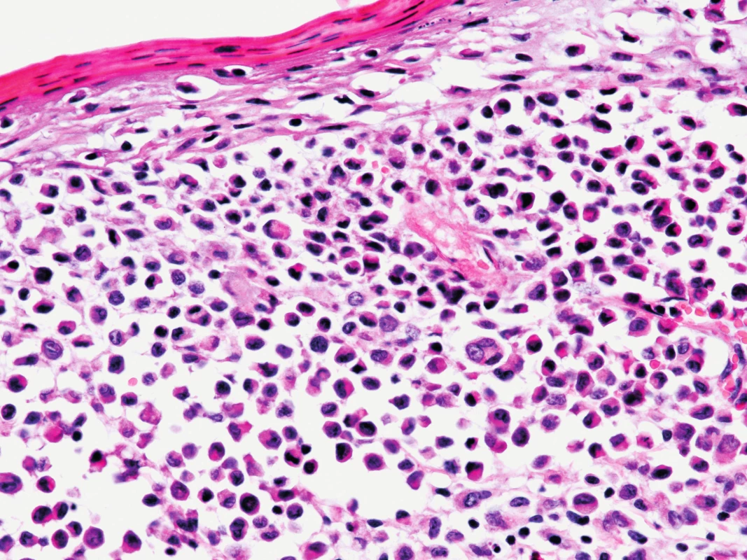 Kožní biopsie při barvení hematoxylin-eosinem, 400x zvětšeno, detail na nádorové elementy: eozinofilní cytoplazma, ledvinovité jádro, vícejaderné elementy, příměs eozinofilů při spodině.
Fig. 5. The skin biopsy, hematoxylin eosin staining, 400x enlargement, a detail of tumorous elements: eosinophilic cytoplasm, kidney-shape nucleus, multinucleus elements, eosinophils in the buttom.