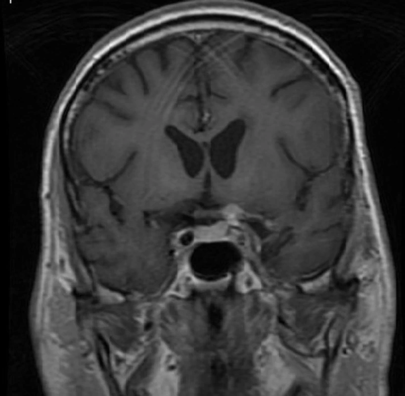 Drobné reziduum meningiomu u levého optického nervu a arteria cerebri interna
Fig. 2: Small residual meningioma adhering to the left optic nerve and internal carotid artery