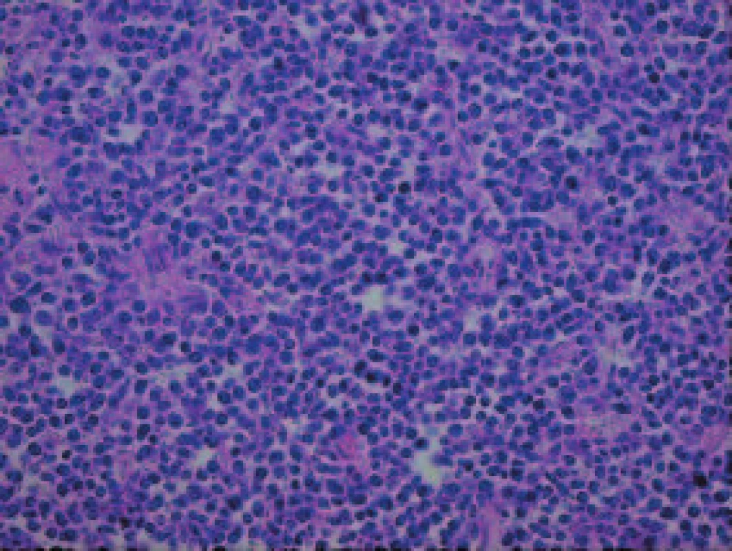 Detail nádorových buněk. Infiltrát je tvořen středně velkými hyperchromními buňkami s nepravidelným jádrem často monstrózního tvaru.