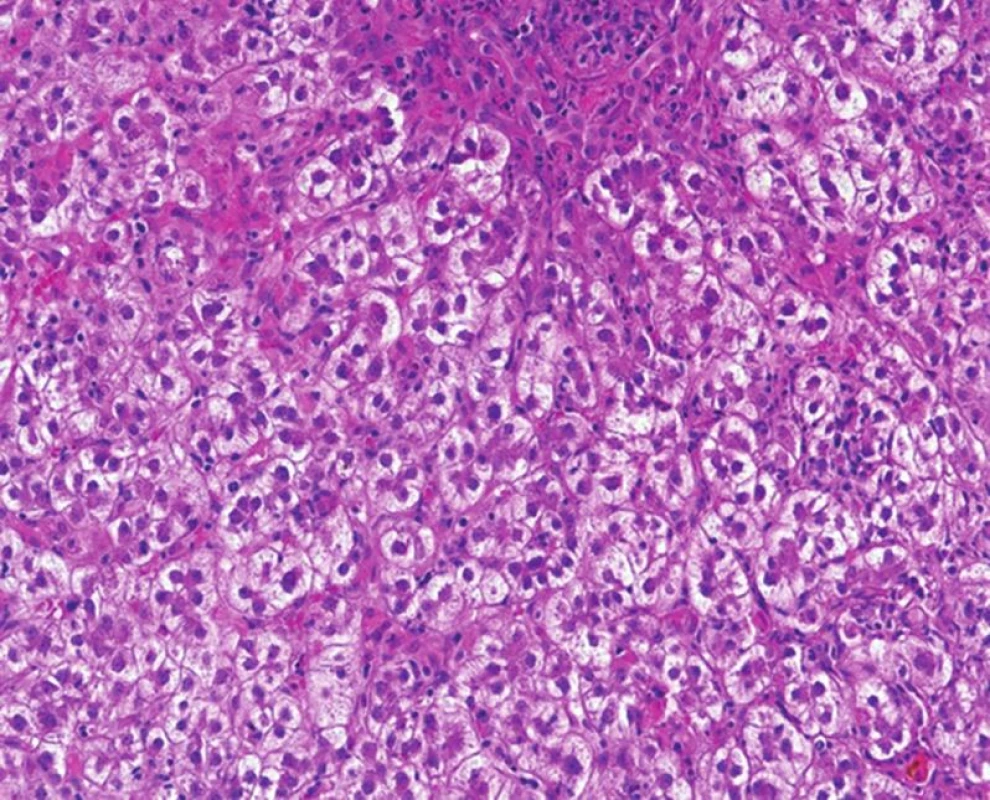 Fibrocholestatická hepatitida s metabolickými změnami hepatocytů, které vytvářejí cholestatické rozety. Minimum zánětlivé celulizace a peritrabekulární fibróza (HE, objektiv 20x).