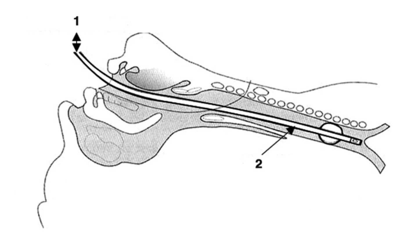 Schematické znázornenie zavedenej „úzkej“ originálnej endotracheálnej kanyly pri „Fantoniho tracheotómii“
1 – Ventilátor konvenčný
2 – ET kanyla s balónom, ID/ED = 5/7–8 mm