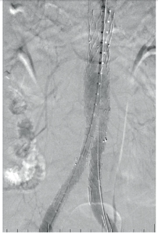 Aneuryzma břišní aorty vyztužené stentgraftem po úspěšné endovaskulární intervenci (EVAR)