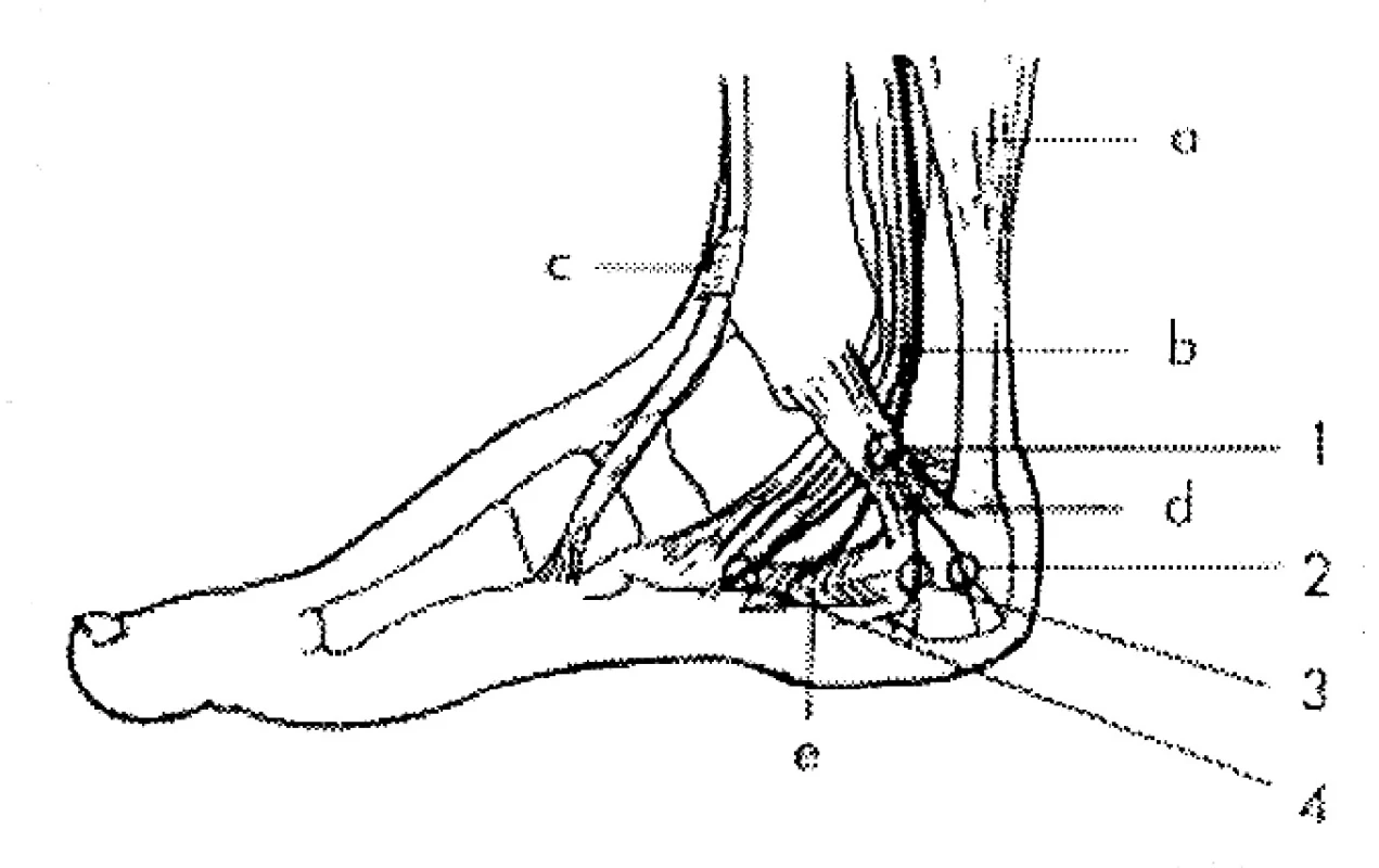 Syndrom mediální tarzálního tunelu
Úžiny:
1 – mediální tarzální tunel,
2 a 3 – rr. calcaneares,
4 – n. plantaris medialis.
Svaly:
a – m. triceps surae,
b – šlacha m. tibialis posterior,
c – šlacha m. tibialis anterior,
d – ligamentum lanciniatum,