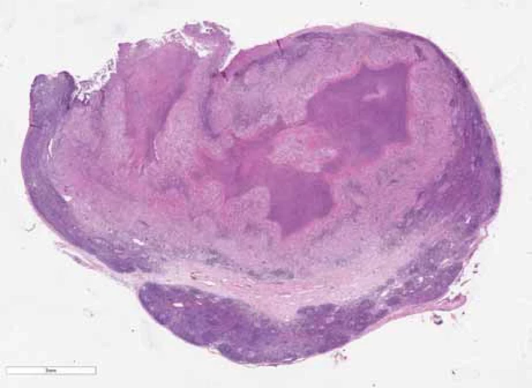 Přehled lymfatické uzliny postižené netuberkulózním zánětem rozsáhlými nekrózami (hematoxylin-eozin).