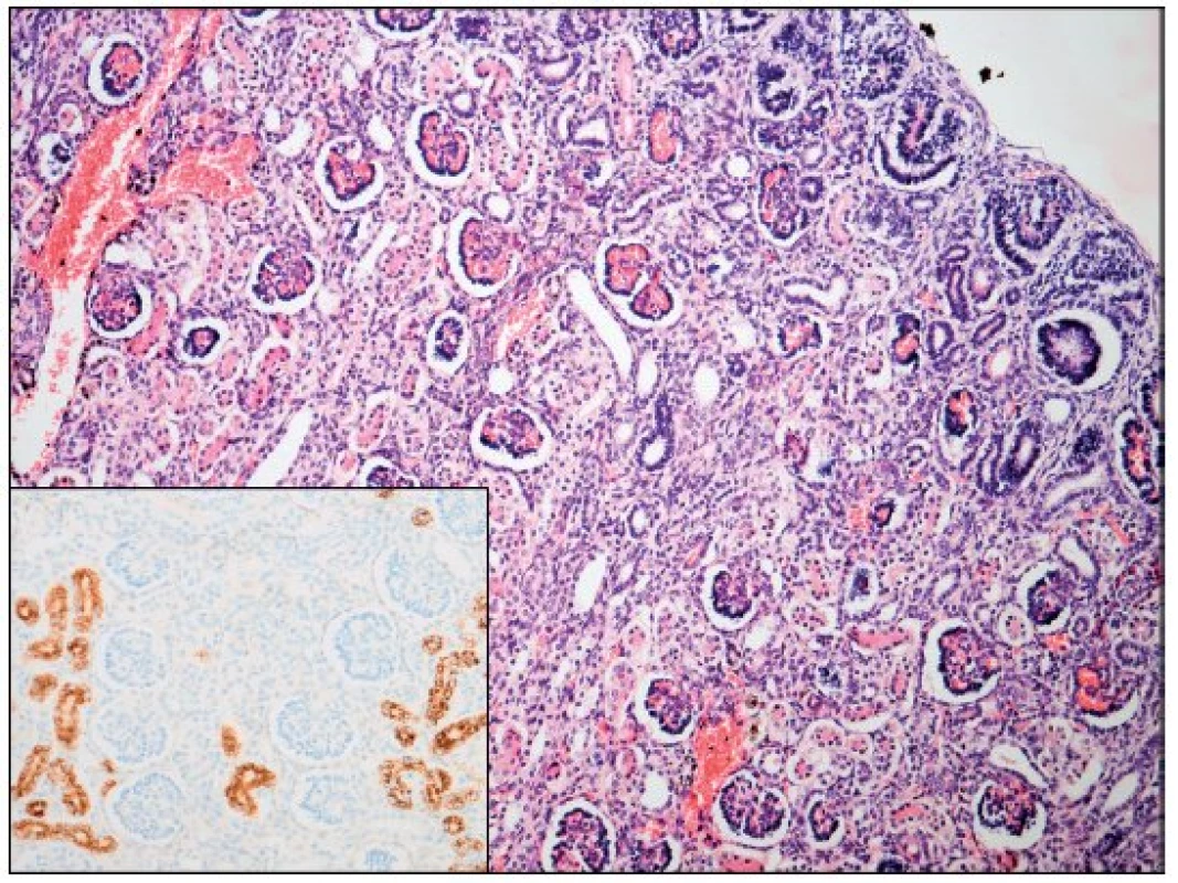 Ledvina – renální tubulární dysgeneze (hematoxylin - eosin; AMACR; zvětšení 100; počet proximálních tubulů 18/mm&lt;sup&gt;2&lt;/sup&gt;).
Fig. 1. Kidney – renal tubular dysgenesis (hematoxylineeosine and AMACR; magnification 100; proximal tubules count 18 per mm&lt;sup&gt;2&lt;/sup&gt;).