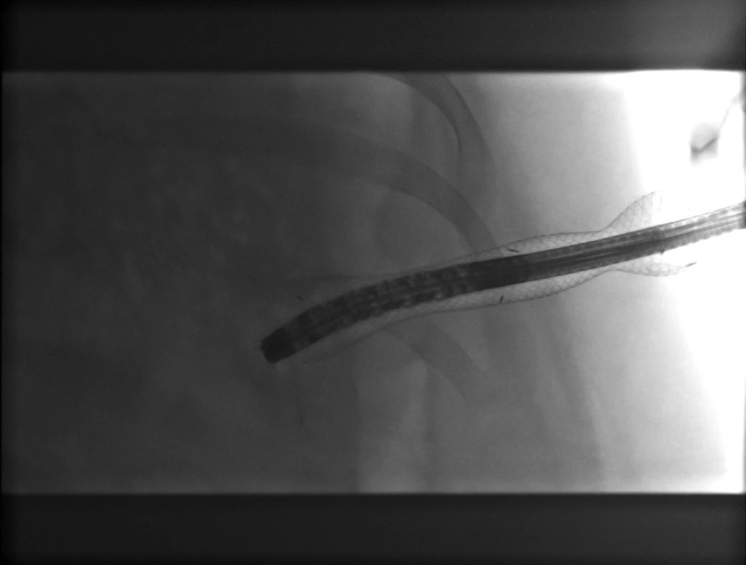 Perkutánní endoskopická nekrektomie – RTG obraz
Fig. 3: Percutaneous endoscopic necrectomy - X-ray finding