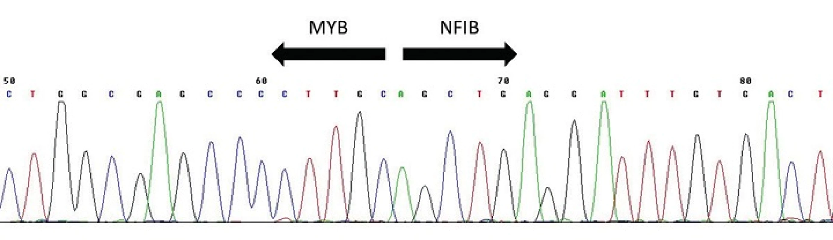 Sekvenogram fúzního transkriptu &lt;i&gt;MYB-NFIB&lt;/i&gt;. Šipky vyznačují místo fúze.