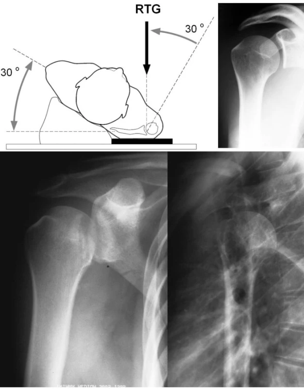 RTG diagnostika: a) správně provedený RTG snímek ramene, b) nález zadní luxace ramene na RTG (AP a transtorakální snímek)
Pic. 1. X-ray: a) a correct shoulder x-ray view, b) x-ray findings of posterior dislocation of the shoulder (AP and transthoracic views)