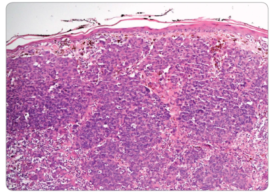 Histologický vzhled nodulárního melanomu – populace zjevně maligních elementů roste difuzně v koriu, složka v oblasti dermo-epidermální junkce chybí. Na periferii nádorových ostrůvků je vidět lymfocytární reakce (hematoxylin-eosin; 100×).