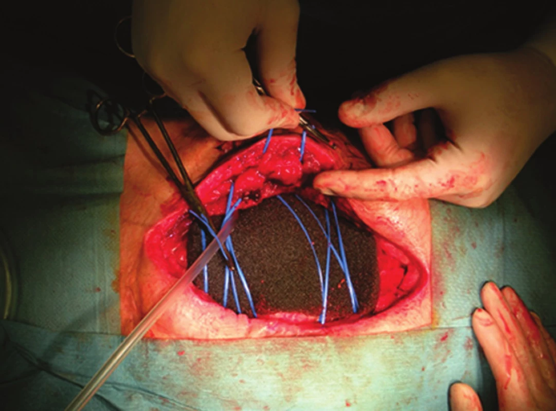 Dynamická sutura stěny břišní
Fig. 3: Dynamic abdominal wall suture