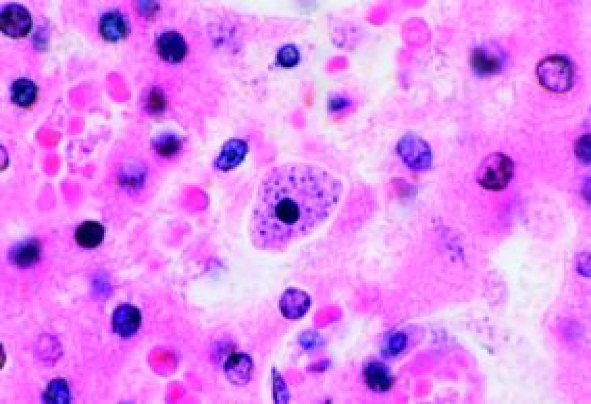 Granulomatózní zánět, množství gigantických buněk, bezbičíkaté parazitární formy v makrofázích (HE ).