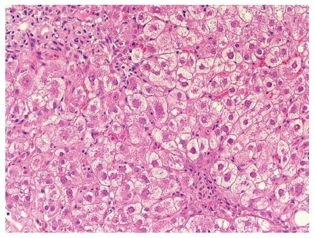 Detail okraje portálního pole s marginální duktulární proliferací s polynukleáry dokonale napodobuje poruchu žlučové drenáže. Zduřelé a cholestatické hepatocyty s minimem zánětlivé celulizace. HE, objektiv 40x.
