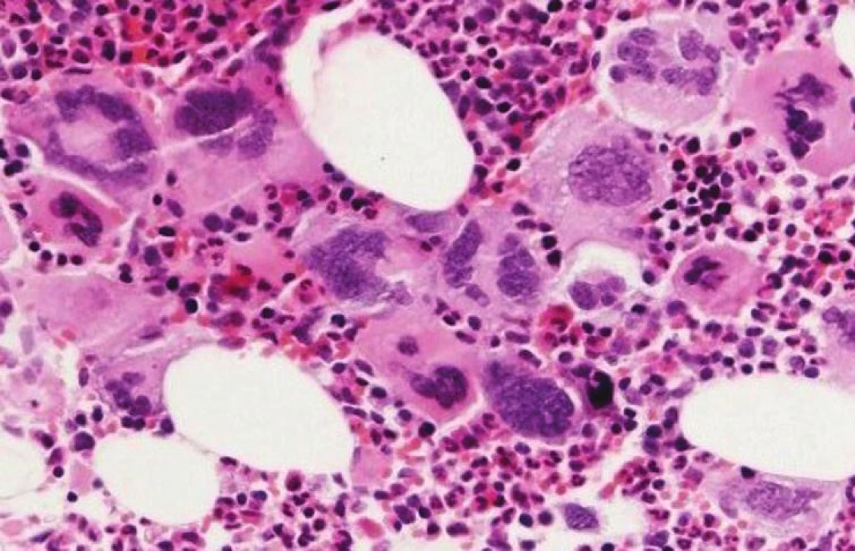 Morfológia MGK pri ET – voľné zhluky veľkých mgk s objemnými, hyperlobulizovanými, hlboko lobulizovanými jadrami bez dysplázií („jelenie parohy“ – viz vpravo hore) (hematoxylín-eozín 200x).
