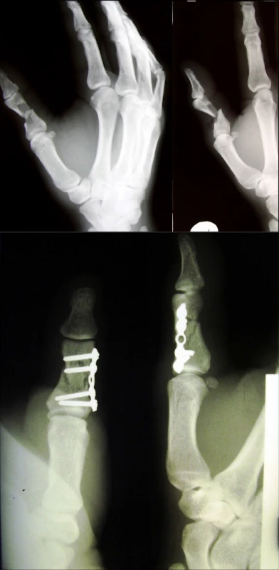 Šikmá zlomenina diafýzy (a) s dlahovou osteosyntézou (b)