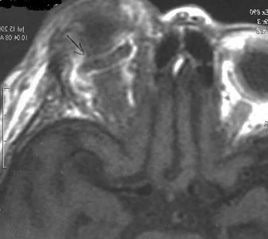 MR snímka očníc, šípkou je vyznačená dilatovaná ľavá horná žila očnice