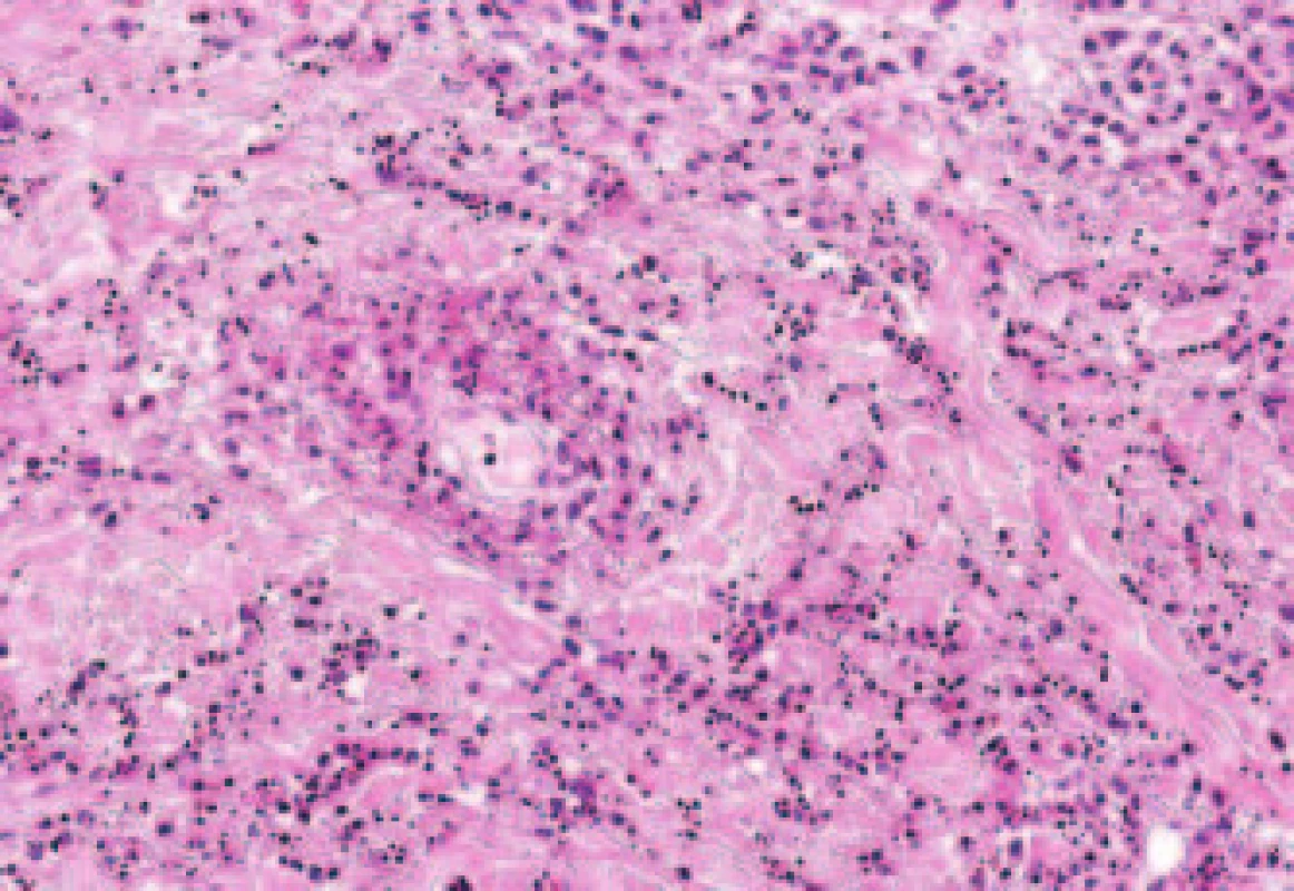 Histologický obraz zachycující cévu s depozity fibrinu, neutrofilní granulocyty s jadernou drtí a mírné  krvácení. Barvení hematoxylin-eozin, objektiv PIApo 40krát.