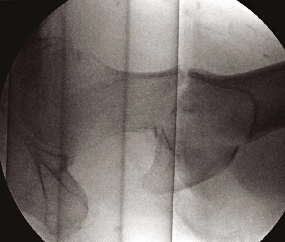 Axiální snímek zlomeniny proximálního femuru