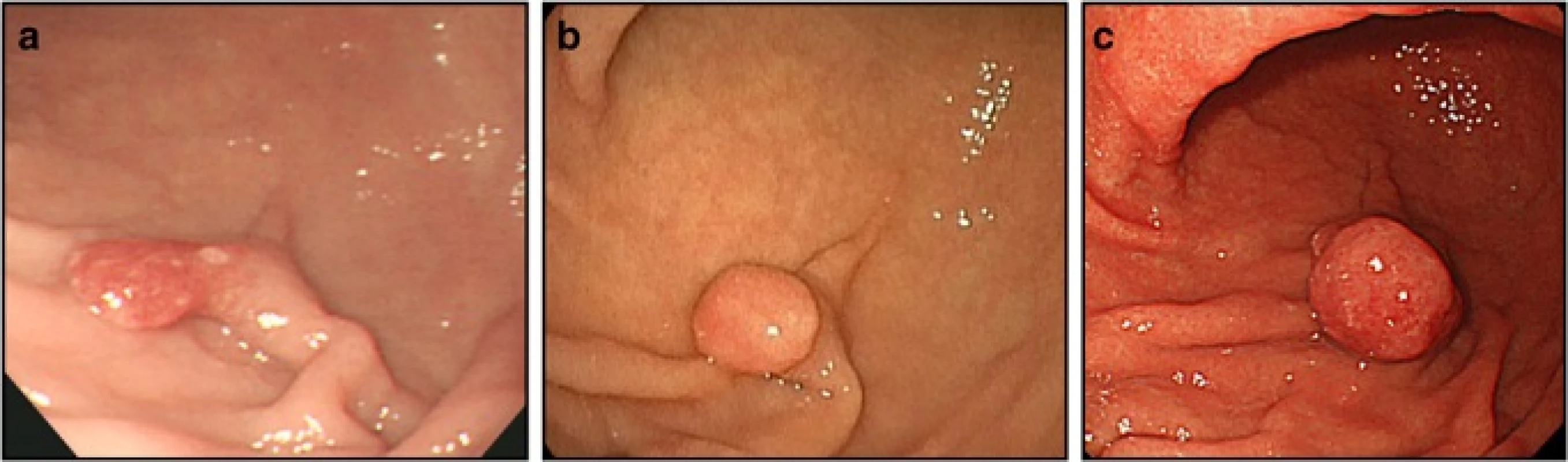 Endoscopy findings. a. In 2005, a pedunculated polyp measuring approximately 10 mm in diameter was observed on the greater curvature of the lower gastric body. The surface of the polyp was slightly reddish. On biopsy, the lesion was diagnosed as a hyperplastic foveolar polyp. b. In 2013, the pedunculated polyp on the greater curvature of the lower gastric body had grown to 12 mm in diameter. The head of the polyp was more rounded compared to the image taken in 2005. c. In 2014, the pedunculated polyp on the greater curvature of the lower gastric body had grown to 20 mm in diameter. The head of the polyp was slightly reddish, more rounded, and tense