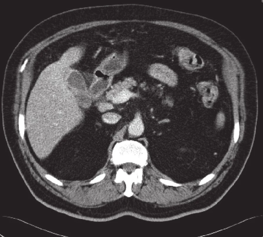 Zesílení stěny žlučníku a zánětlivá infiltrace jater při jeho fundu
Fig. 1: Thickness of gall bladder wall and liver inflammatory infiltration near the fundus