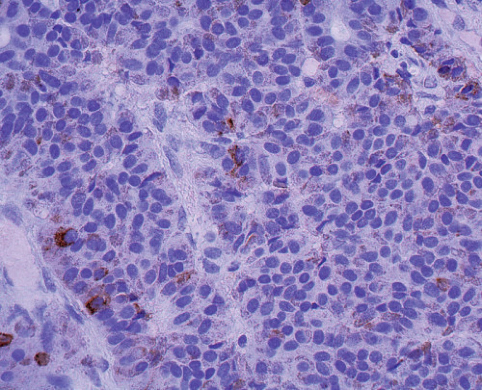Granulární pozitivita nádorových buněk s protilátkou proti chromograninu A, 400krát