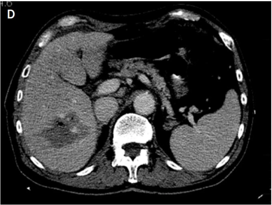 A – na axiálním CT skenu je patrná metastáza karcinomu prostaty v pravém jaterním laloku před IRE (šipka); B – počáteční uložení dvojice elektrod; C – konečná pozice dvojice elektrod; D – rozsah nekrózy po IRE