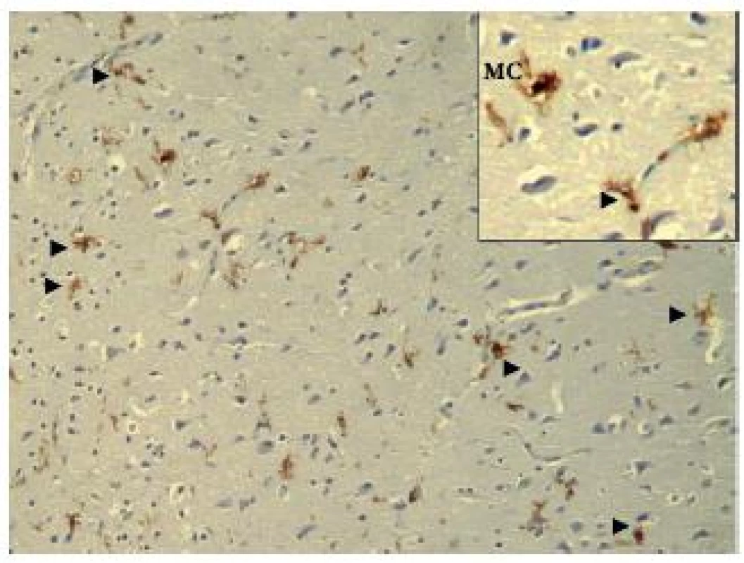A case of 74 years old pedestrian knocked down during trafic accident who suffered brain contusions. MC – microglial cell. Arrowhead indicates PSGL immunopositivity of perivascular ramified MC (see in detail).