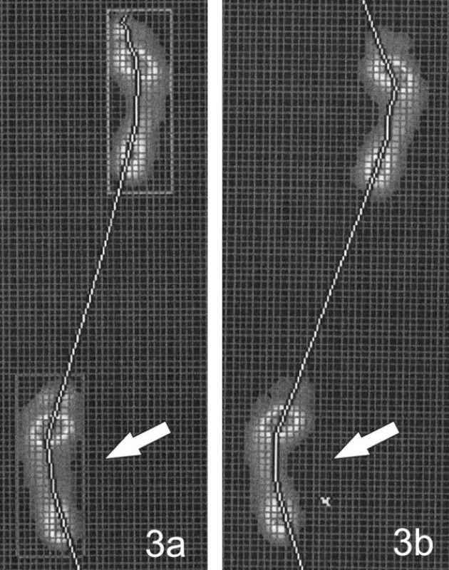 Záznam z FDM desky: 3a) Propadající se podélná klenba: projasnění otisku na mediální straně je širší na levé noze při vyšetření spontánní chůze, 3b) otisk nohy po instrukci: „vnímejte zevní hranu chodidla“ – na mediální straně levé nohy došlo ke zúžení projasnění otisku, tj. ke zlepšení podélné klenby nohy.