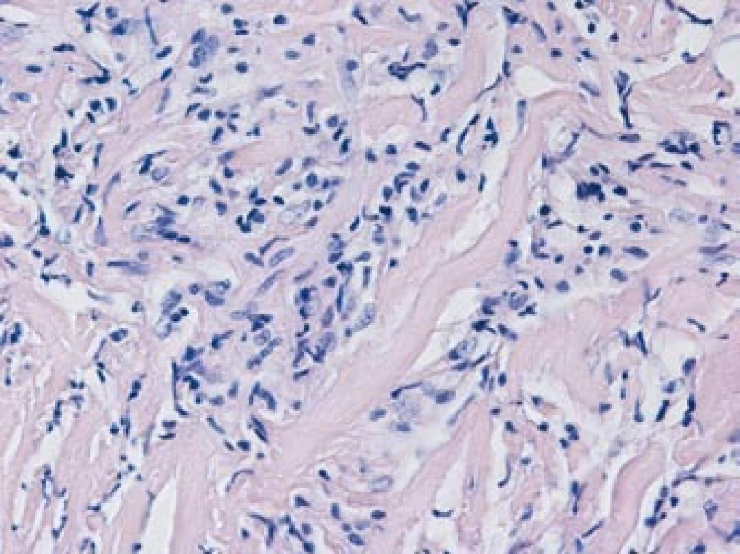 Histologické vyšetření: bohatě fibrotizovaná tkáň, tvořená sítí širokých kolagenních vláken s ložisky chronického zánětlivého infiltrátu, tvořeného zejména lymfocyty, zralými plazmatickými buňkami a ojedinělými histiocyty, s relativním nedostatkem neutrofilních granulocytů.