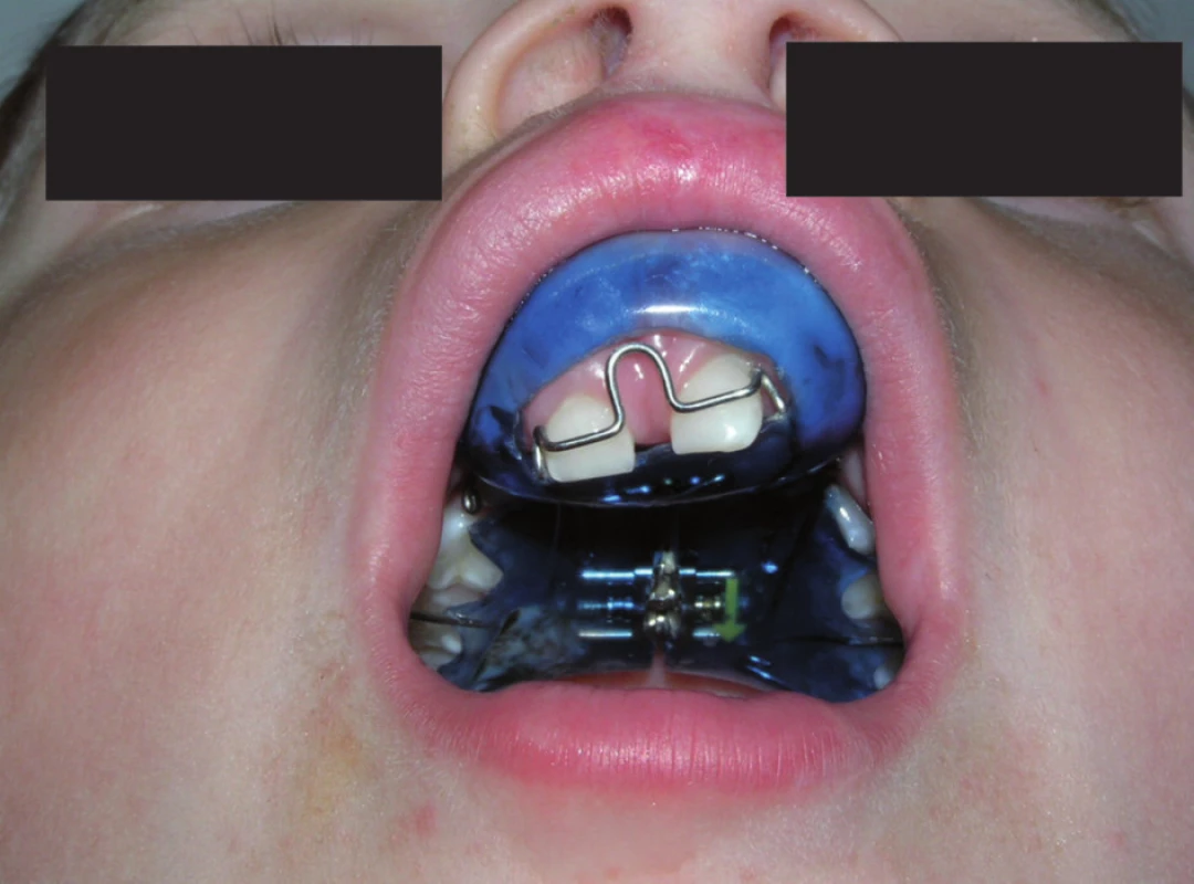 Pacient s oboustranným celkovým rozštěpem ve věku 4 a půl roku s nasazeným snímacím ortodontickým aparátem pro zlepšení vertikálních a transverzálních vztahů čelistních segmentů.