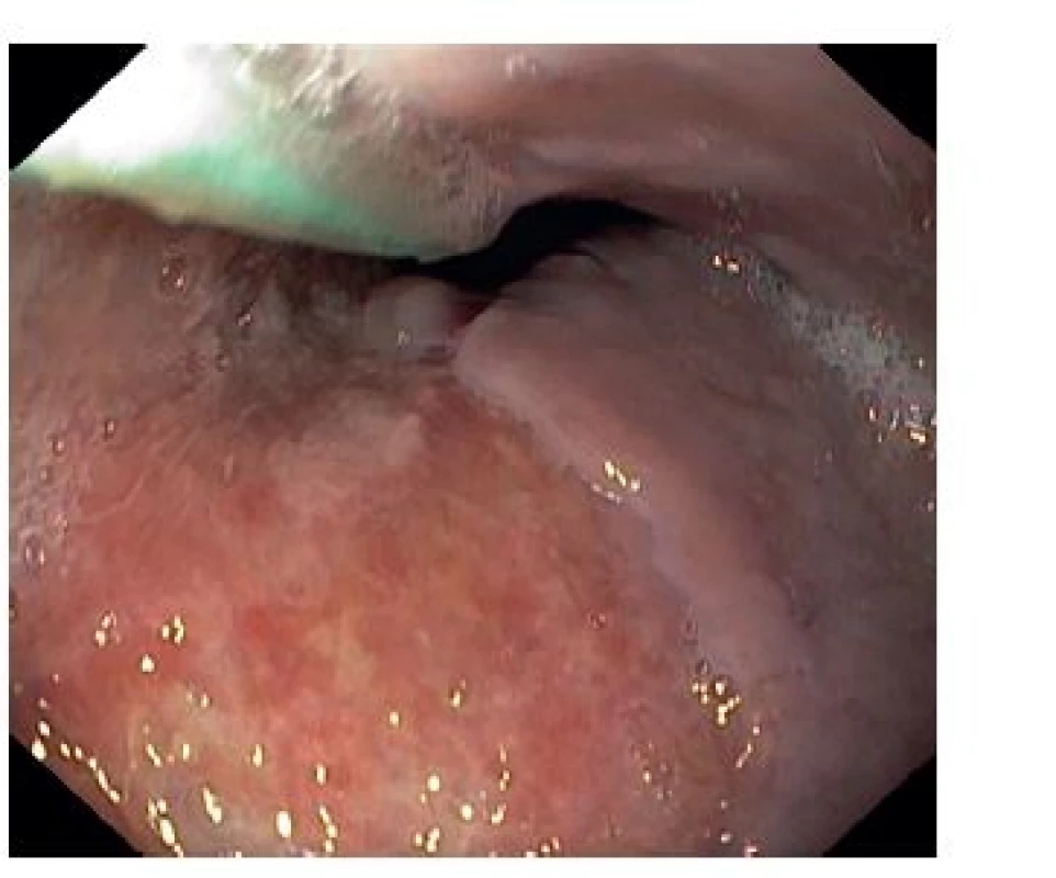 Gastroskopický snímek po 13 dnech s plošnou erozí sliznice
Fig. 4: Upper endoscopy image after 13 days with mucosal surface erosion