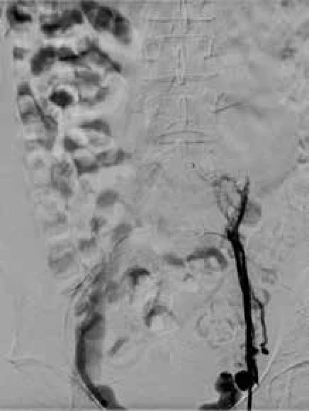Angiografický obraz u pacienta s potrombotickým uzávěrem levostranných pánevních žil.