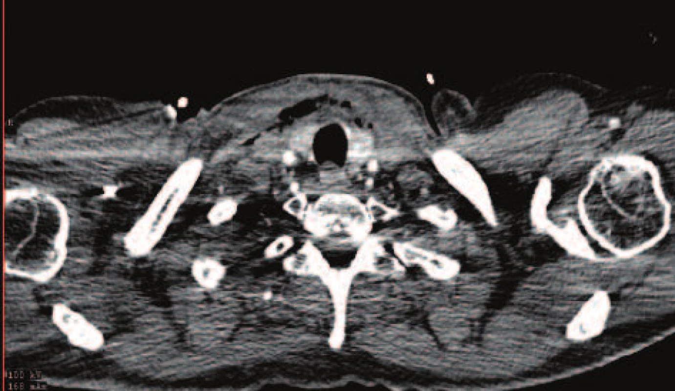CT obraz prosáknutí měkkých tkání krku a emfyzém
Fig. 1: CT image of the neck soft tissue infiltration and emphysema