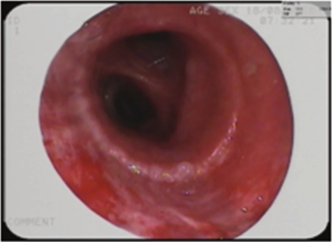 Bronchoskopický pohled: zhojená anastomóza, stav po vytažení stentu
Fig. 7: Bronchoscopic view: healed anastomosis; status after stent extraction