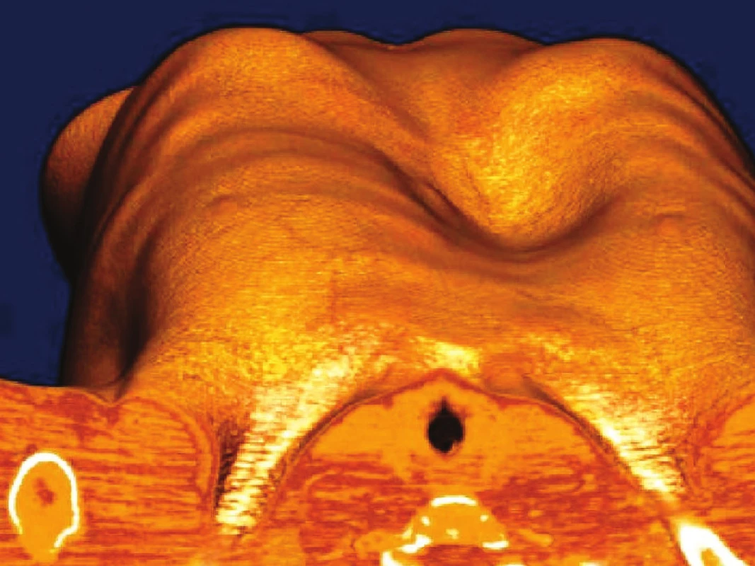 Vyšetření hrudníku počítačovou tomografií před operací: 1a – CT – příčný řez, patrná hluboká deformita s pravostrannou asymetrií; 1b – CT – celotělový pohled
Fig. 1: Computed tomography of the chest wall before surgical correction: 1a – axial NECT show marked chest deformity with right-sided asymetry. 1b – Volume-rendered 3D CT – full-body view